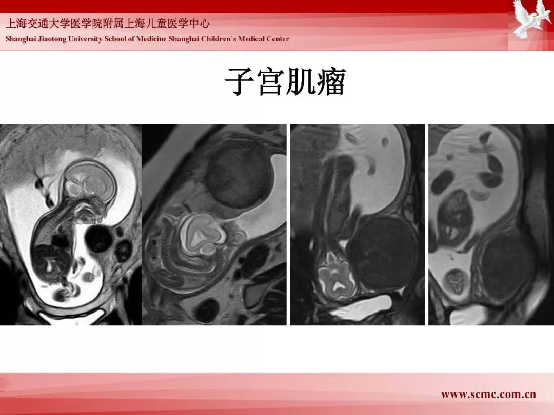 影像PPT - 【PPT】胎儿磁共振检查技术-23