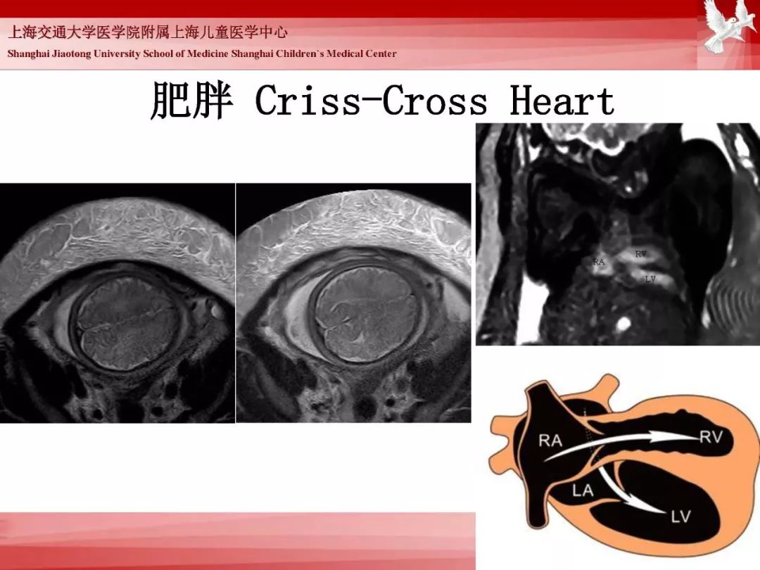 影像PPT - 【PPT】胎儿磁共振检查技术-24