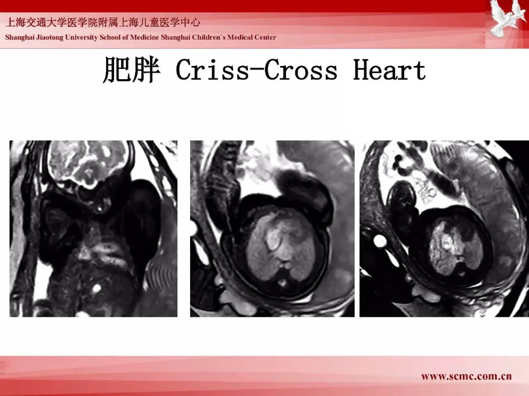 影像PPT - 【PPT】胎儿磁共振检查技术-25