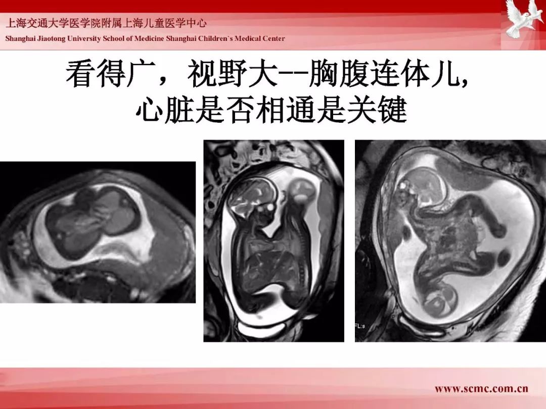 影像PPT - 【PPT】胎儿磁共振检查技术-28