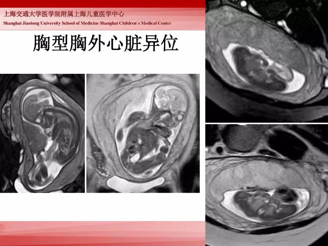 影像PPT - 【PPT】胎儿磁共振检查技术-29