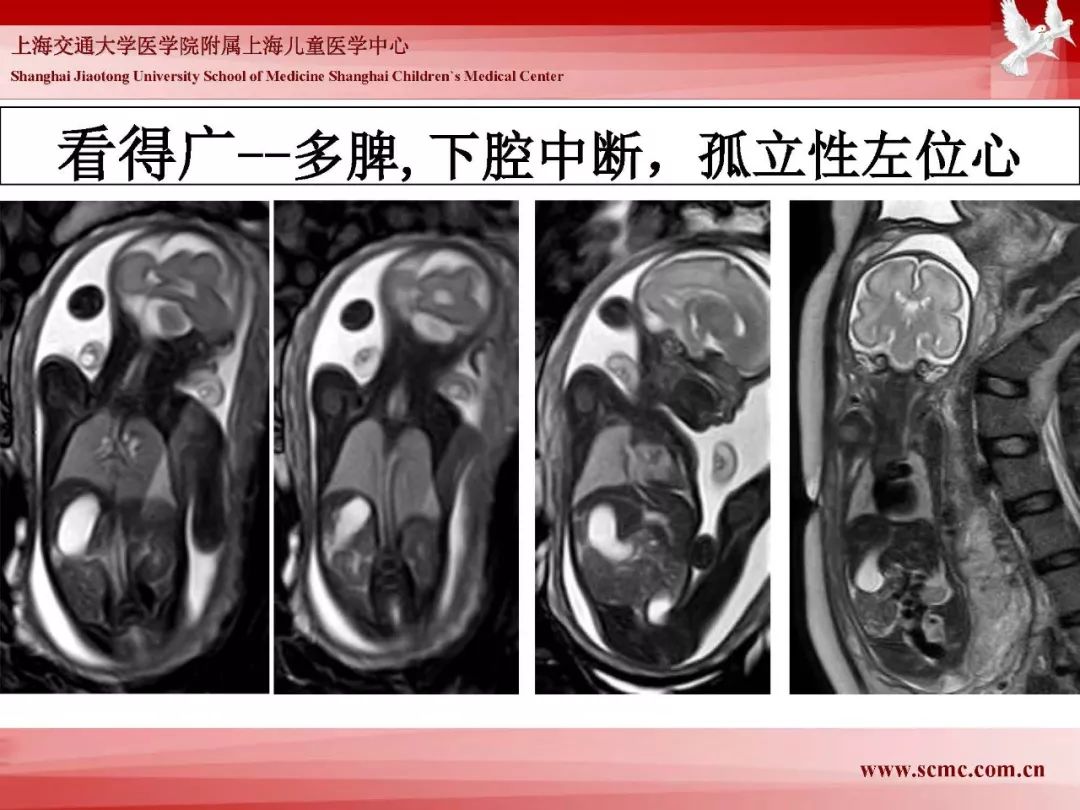影像PPT - 【PPT】胎儿磁共振检查技术-30