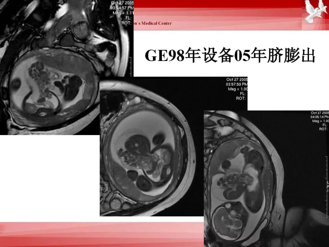 影像PPT - 【PPT】胎儿磁共振检查技术-31