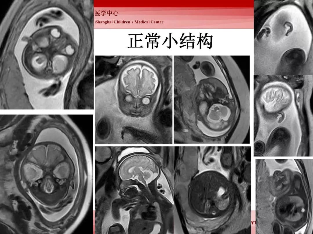 影像PPT - 【PPT】胎儿磁共振检查技术-33