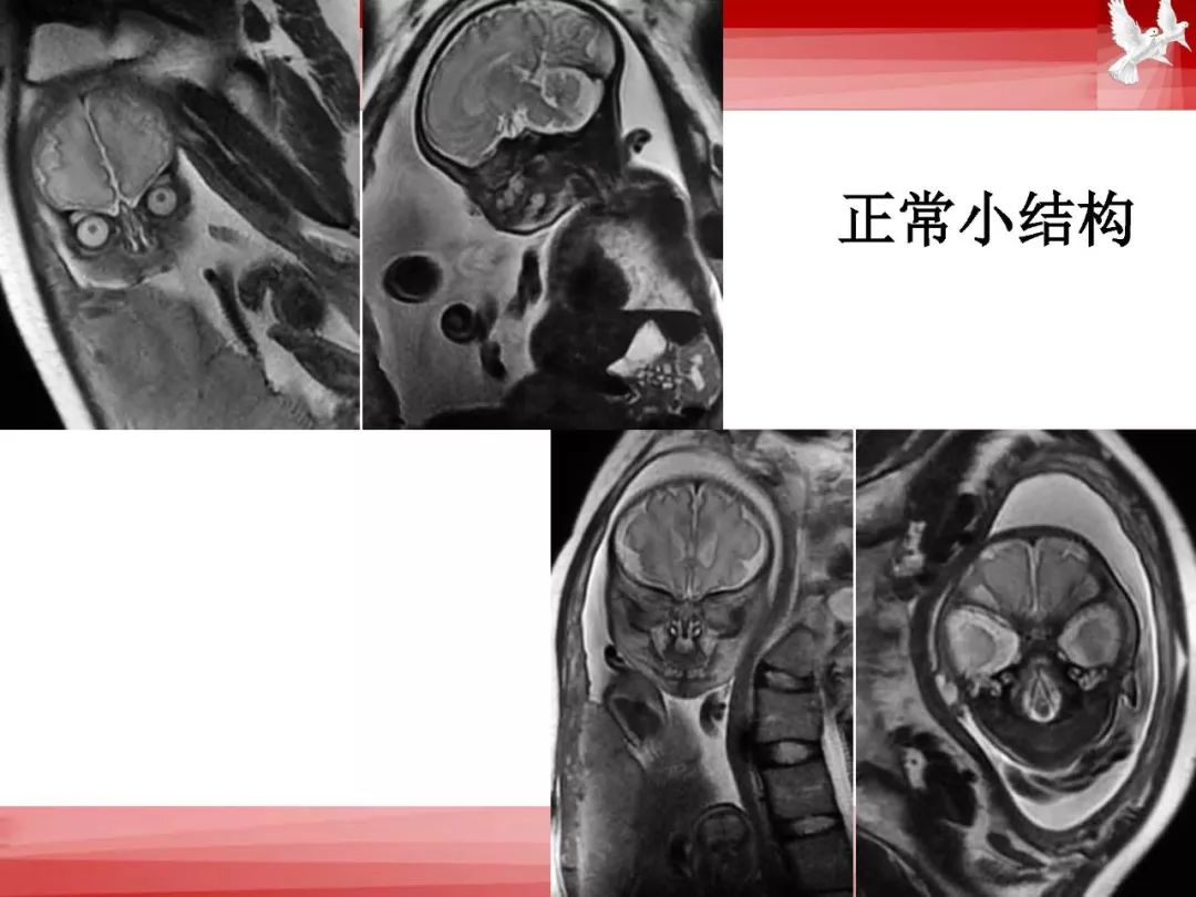 影像PPT - 【PPT】胎儿磁共振检查技术-34