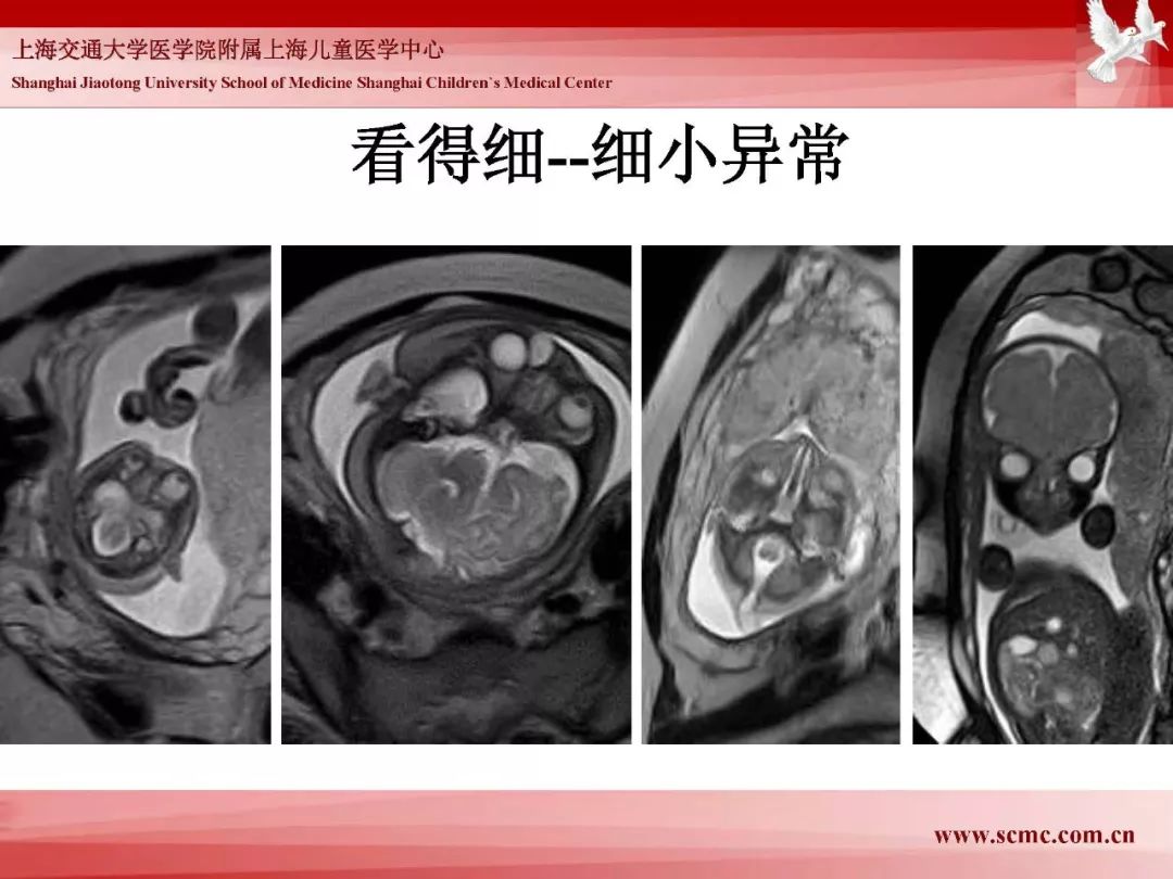 影像PPT - 【PPT】胎儿磁共振检查技术-35