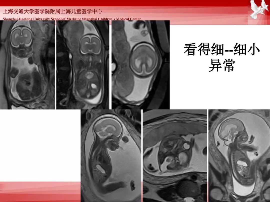 影像PPT - 【PPT】胎儿磁共振检查技术-36