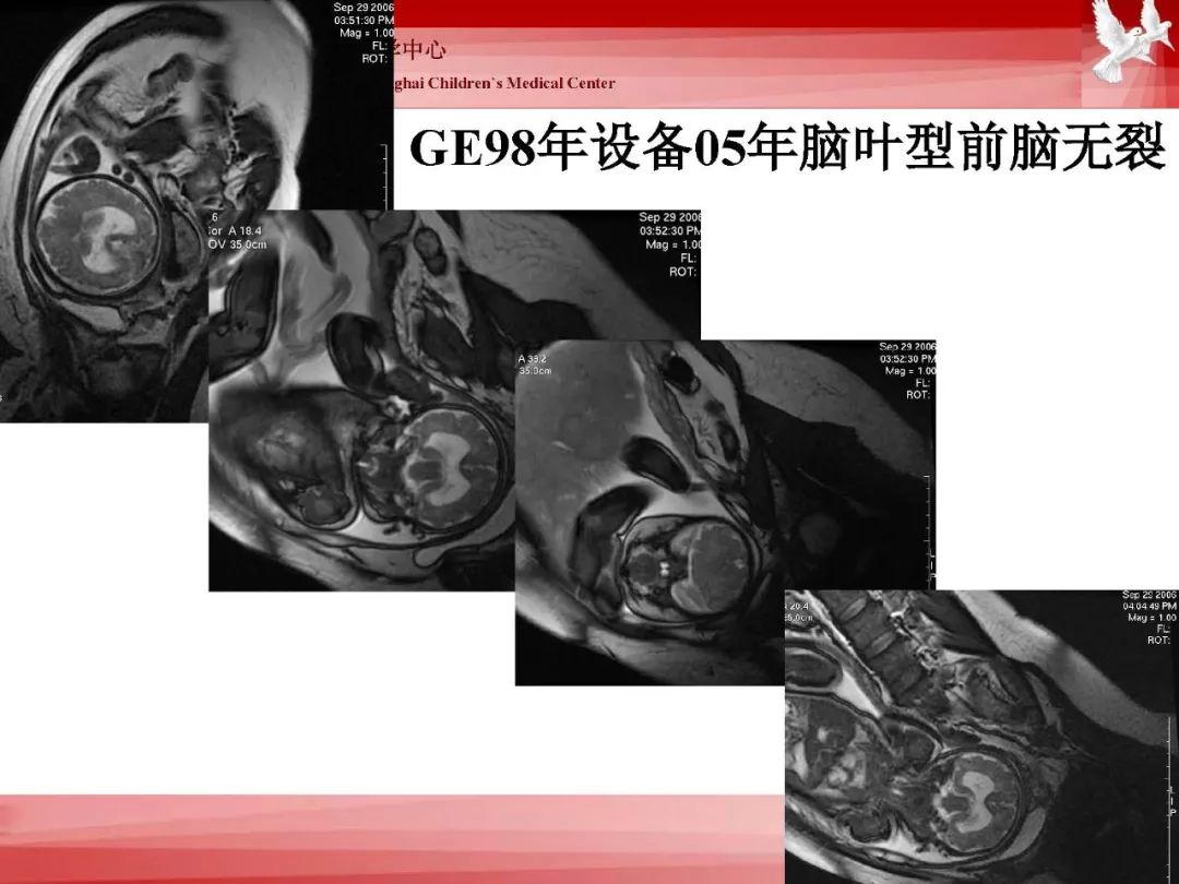 影像PPT - 【PPT】胎儿磁共振检查技术-39