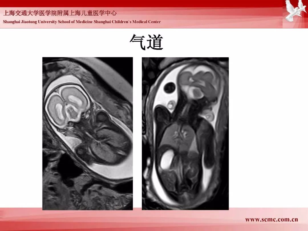 影像PPT - 【PPT】胎儿磁共振检查技术-38