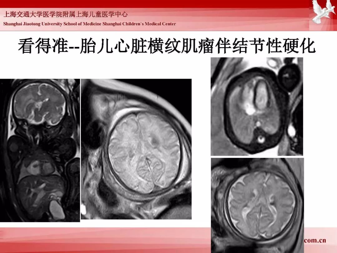 影像PPT - 【PPT】胎儿磁共振检查技术-42