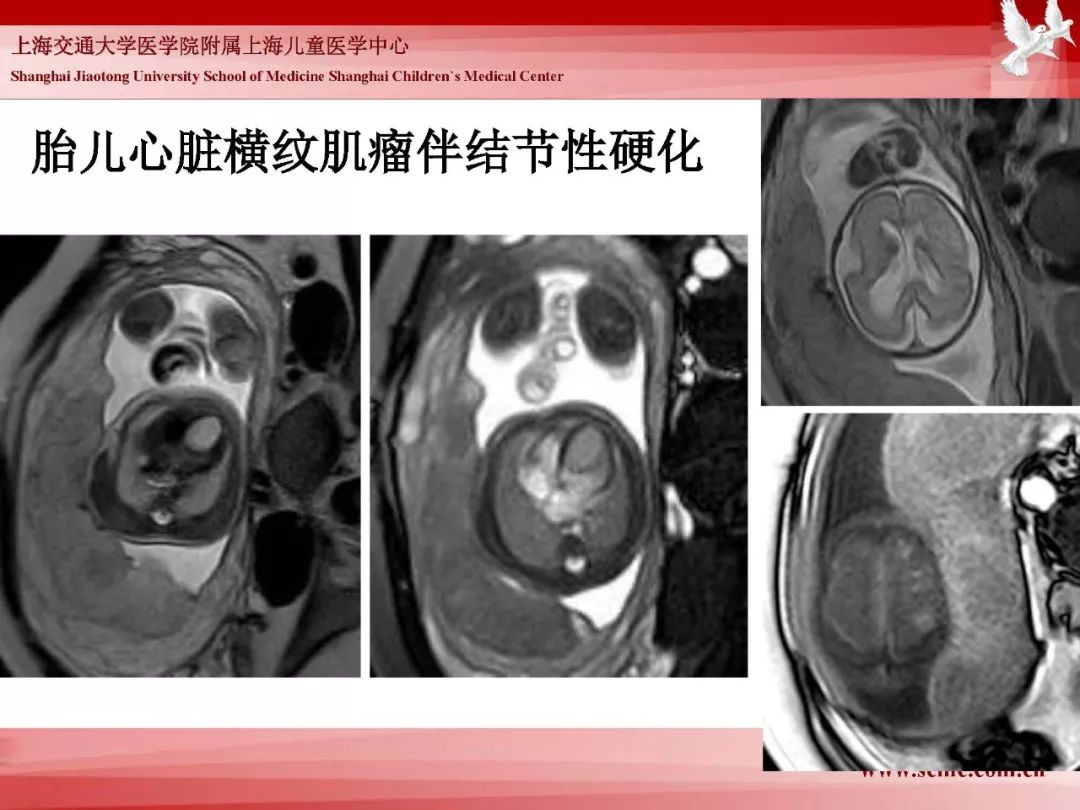 影像PPT - 【PPT】胎儿磁共振检查技术-43