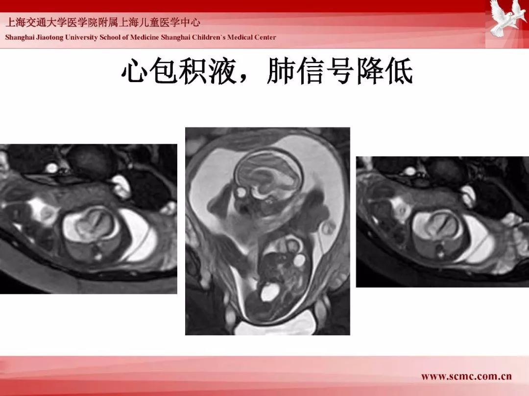 影像PPT - 【PPT】胎儿磁共振检查技术-44