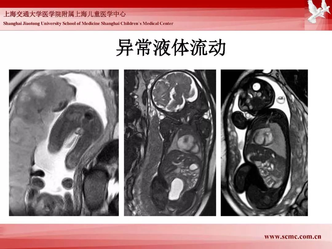 影像PPT - 【PPT】胎儿磁共振检查技术-45