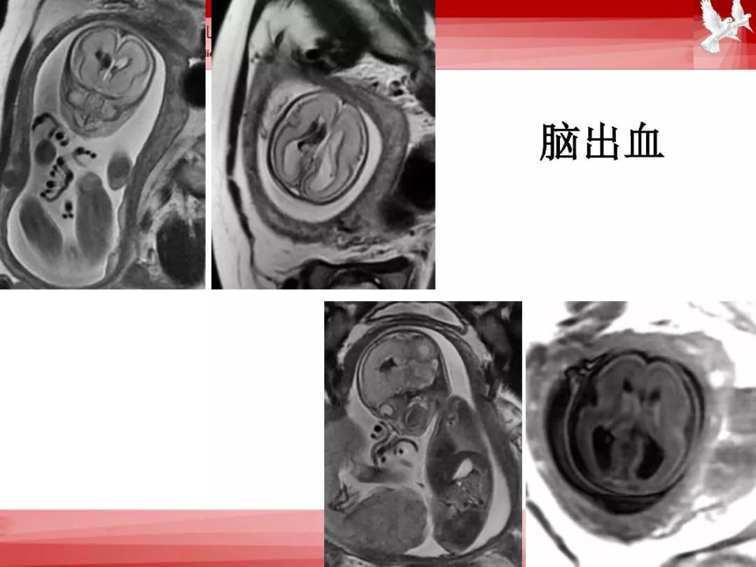 影像PPT - 【PPT】胎儿磁共振检查技术-46