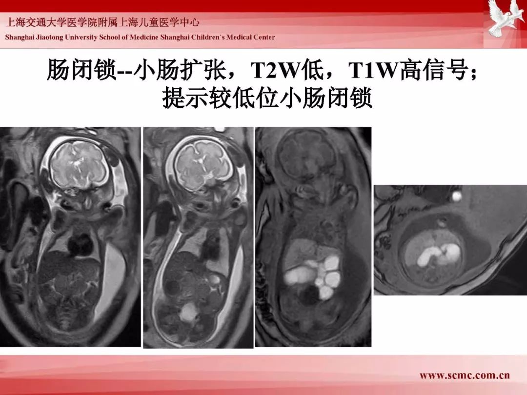 影像PPT - 【PPT】胎儿磁共振检查技术-47