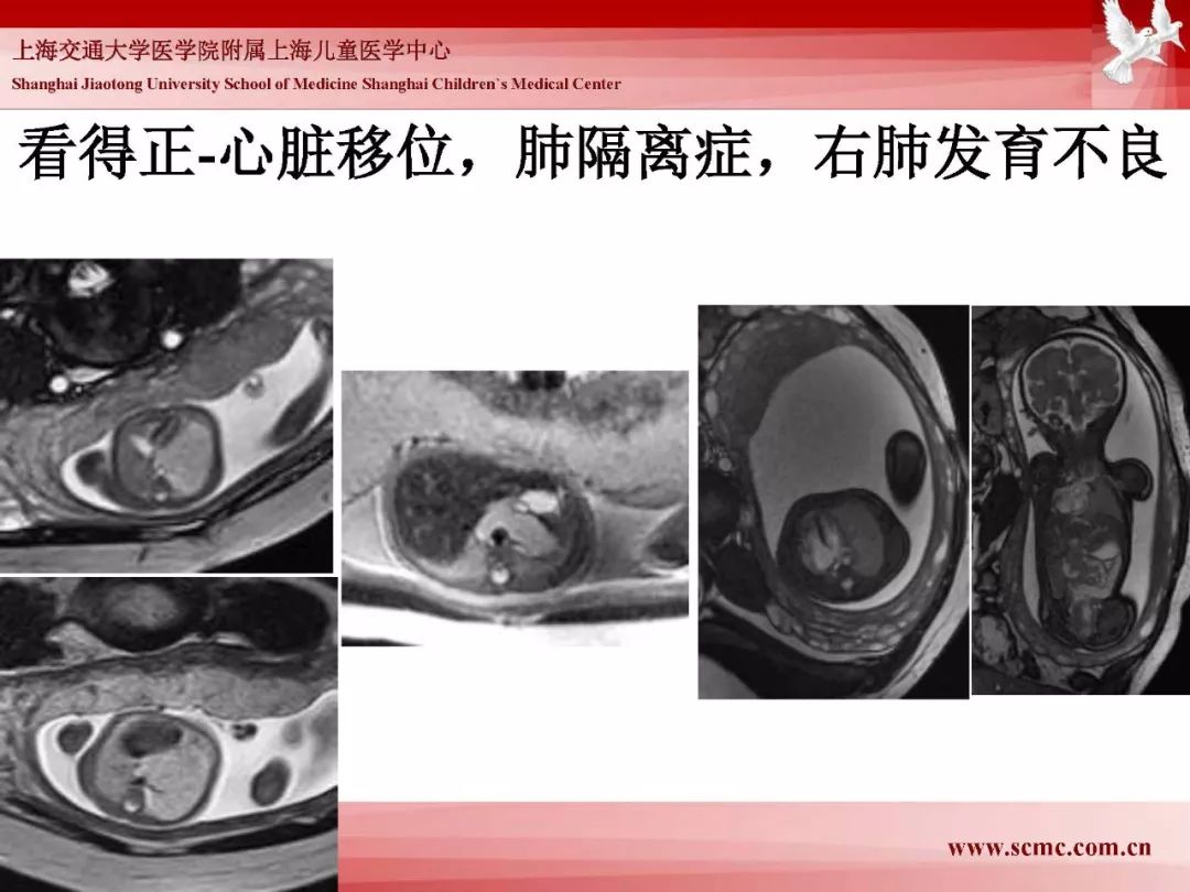 影像PPT - 【PPT】胎儿磁共振检查技术-50
