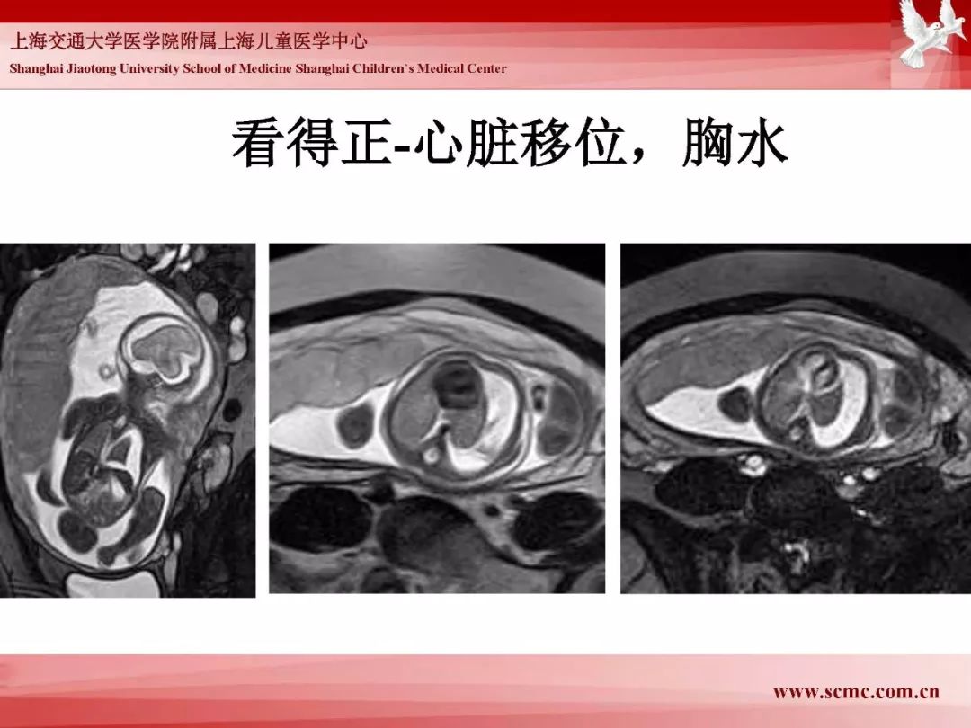 影像PPT - 【PPT】胎儿磁共振检查技术-51