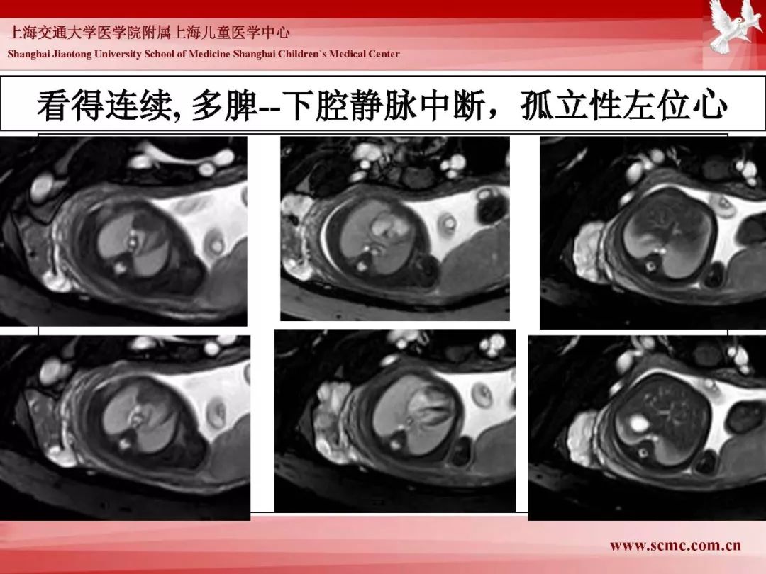 影像PPT - 【PPT】胎儿磁共振检查技术-52