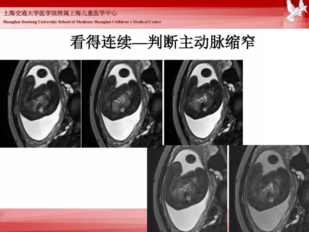 影像PPT - 【PPT】胎儿磁共振检查技术-53