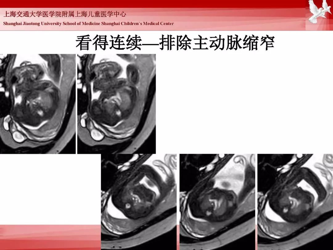 影像PPT - 【PPT】胎儿磁共振检查技术-54