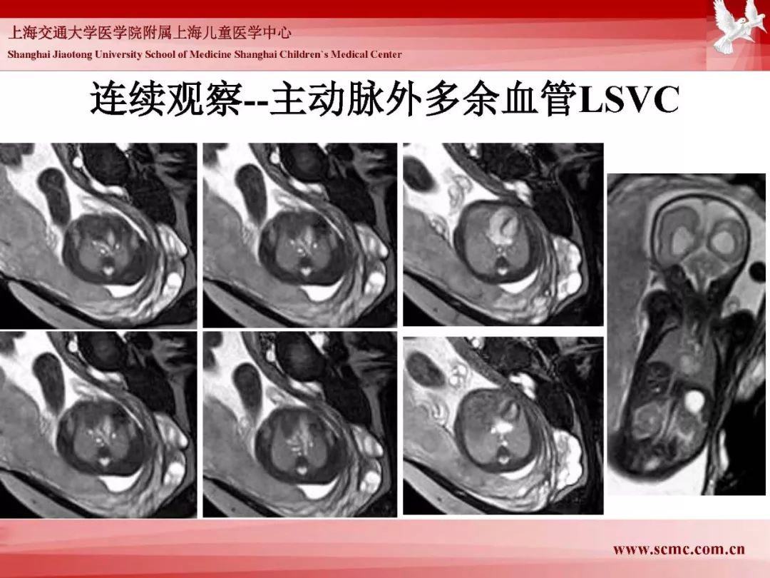影像PPT - 【PPT】胎儿磁共振检查技术-55