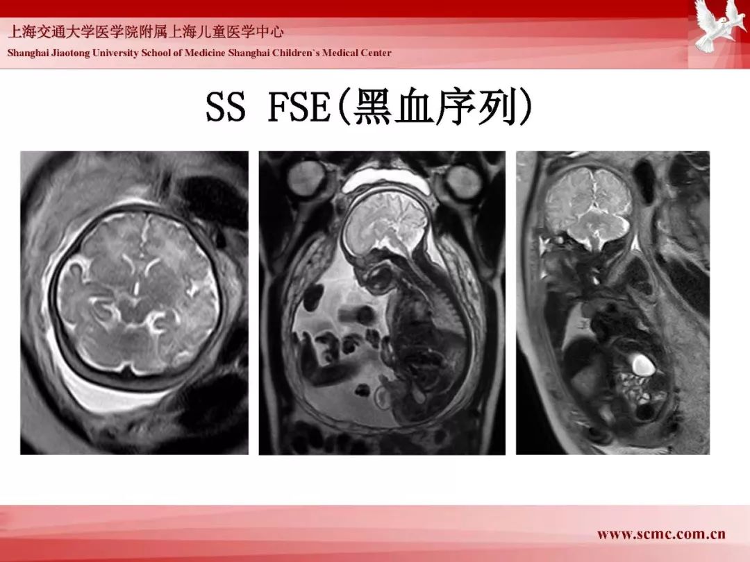影像PPT - 【PPT】胎儿磁共振检查技术-60