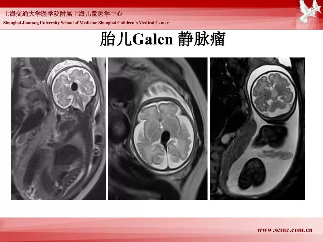 影像PPT - 【PPT】胎儿磁共振检查技术-61