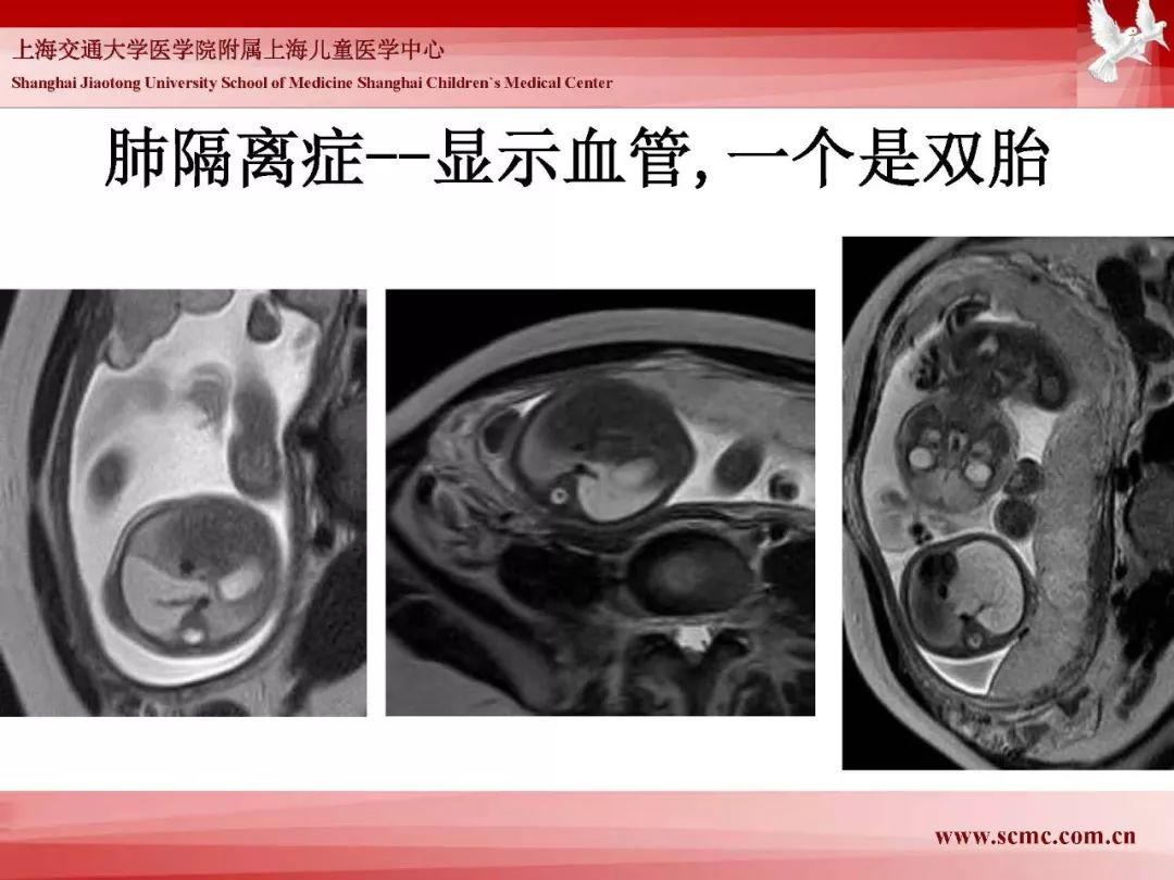 影像PPT - 【PPT】胎儿磁共振检查技术-62