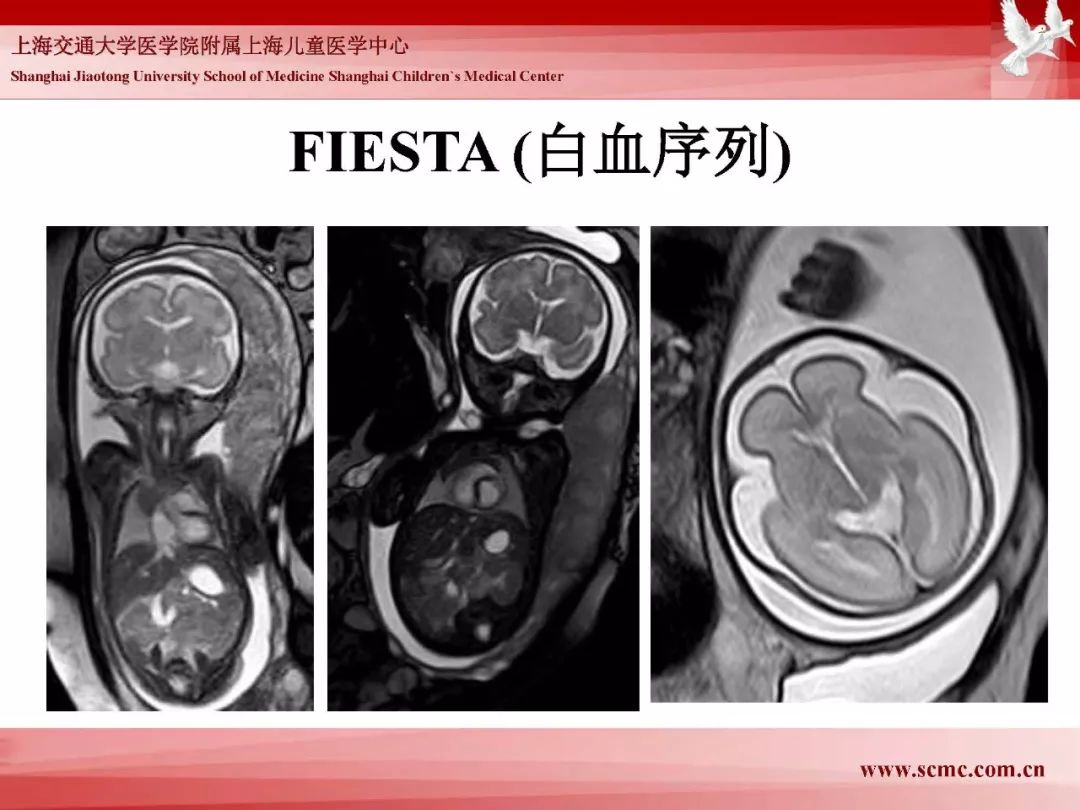 影像PPT - 【PPT】胎儿磁共振检查技术-64