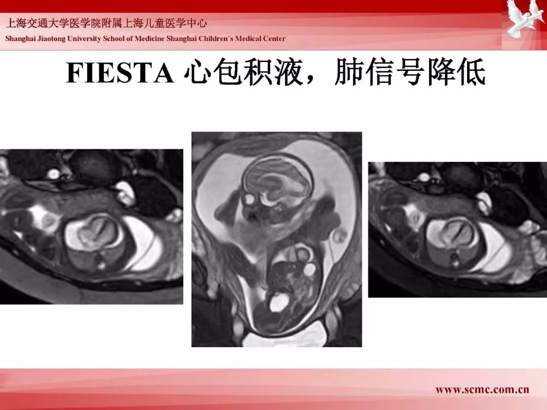 影像PPT - 【PPT】胎儿磁共振检查技术-65