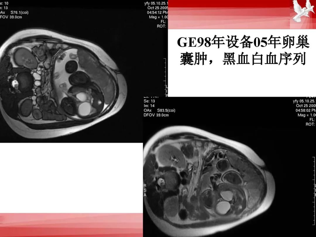 影像PPT - 【PPT】胎儿磁共振检查技术-66