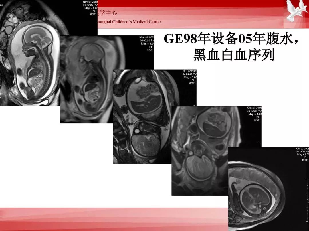 影像PPT - 【PPT】胎儿磁共振检查技术-67