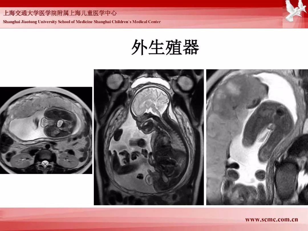 影像PPT - 【PPT】胎儿磁共振检查技术-68