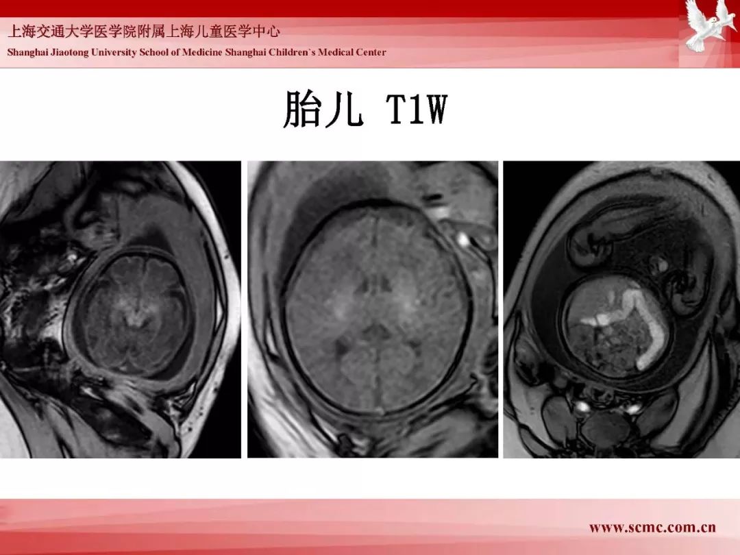 影像PPT - 【PPT】胎儿磁共振检查技术-72