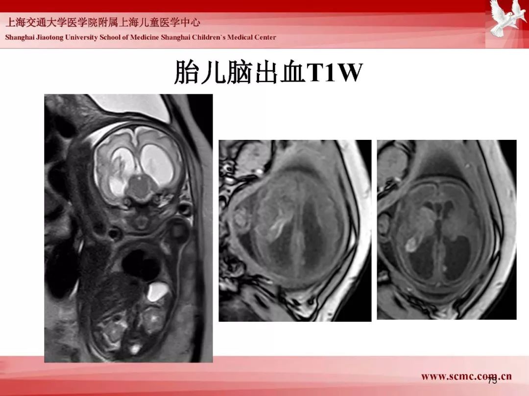影像PPT - 【PPT】胎儿磁共振检查技术-73