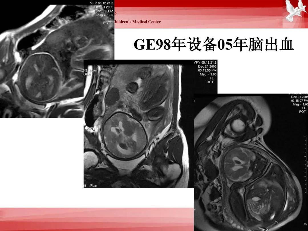 影像PPT - 【PPT】胎儿磁共振检查技术-74