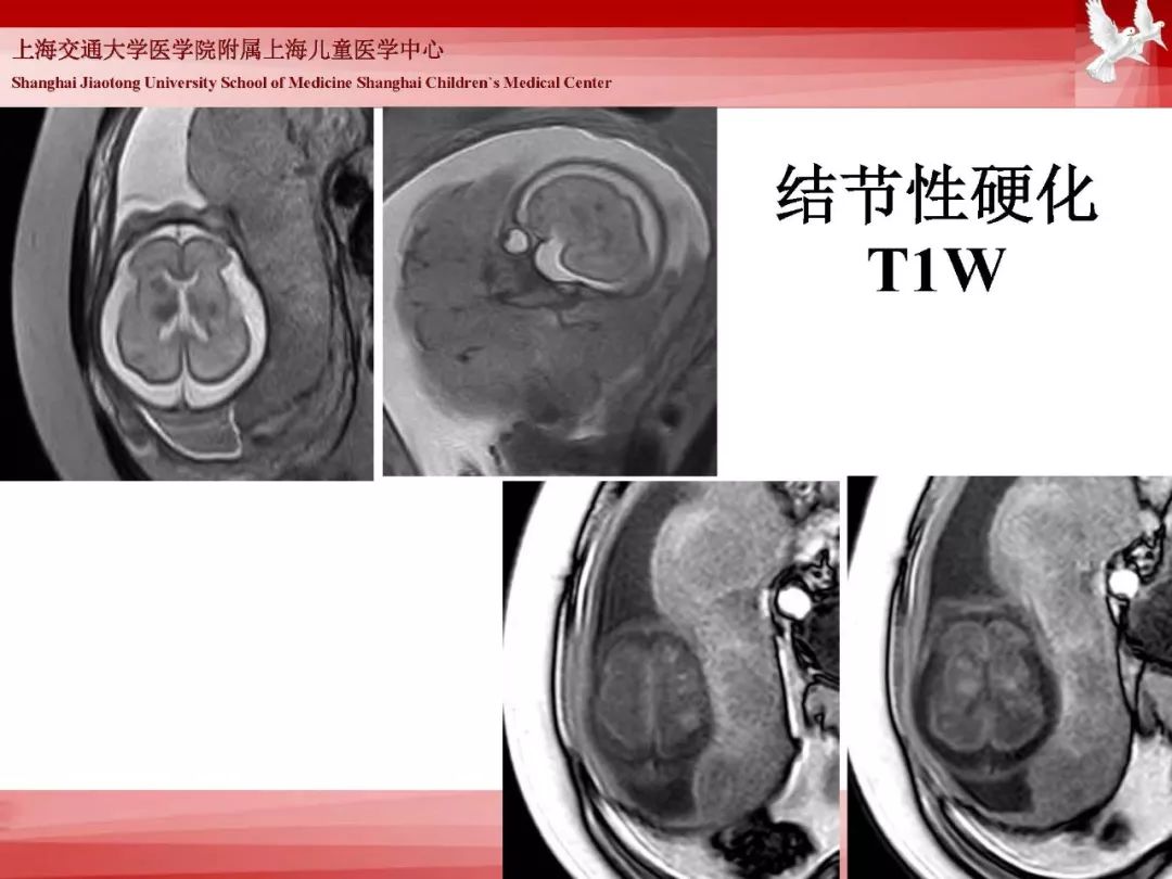 影像PPT - 【PPT】胎儿磁共振检查技术-75