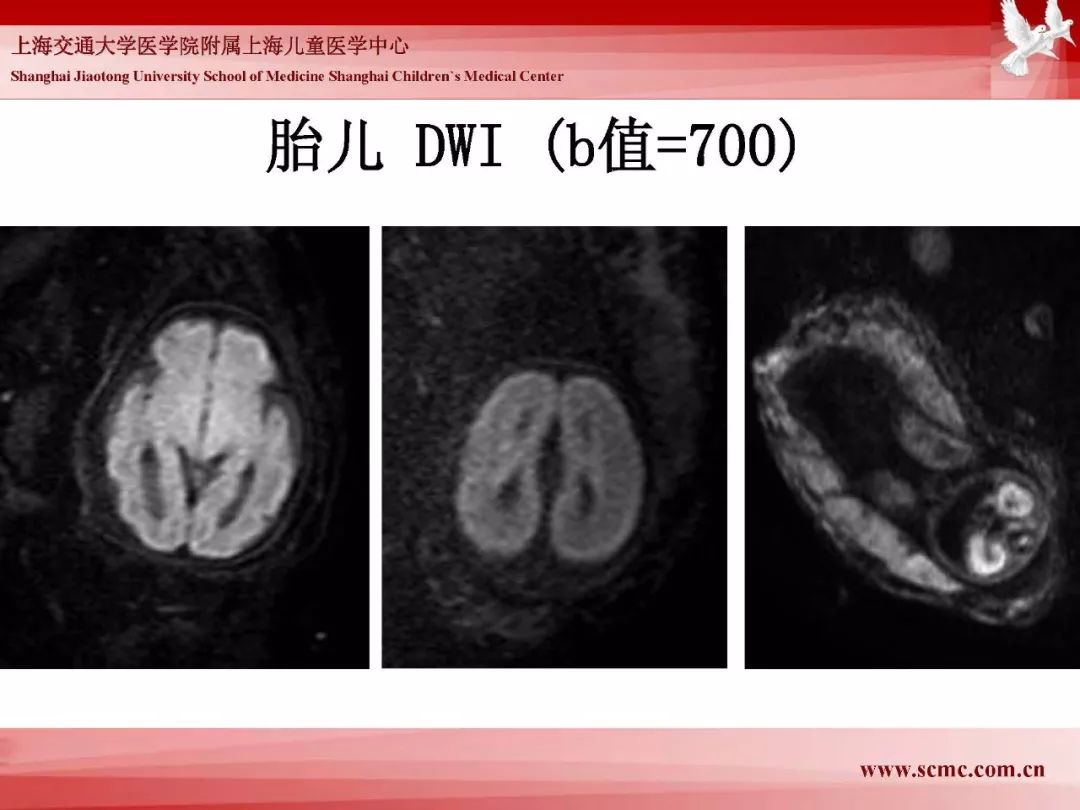 影像PPT - 【PPT】胎儿磁共振检查技术-77