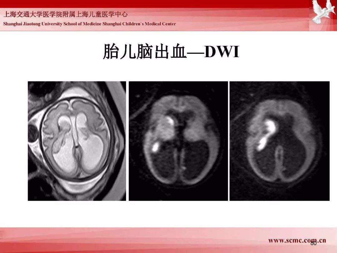 影像PPT - 【PPT】胎儿磁共振检查技术-78