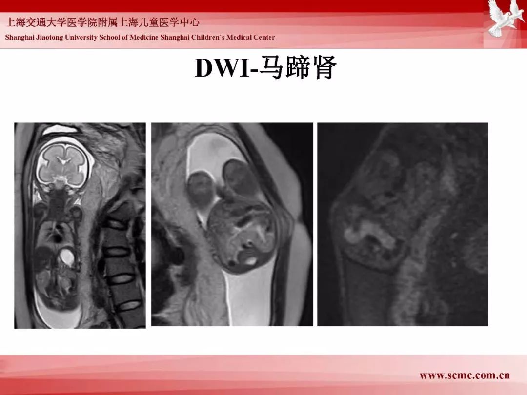 影像PPT - 【PPT】胎儿磁共振检查技术-79