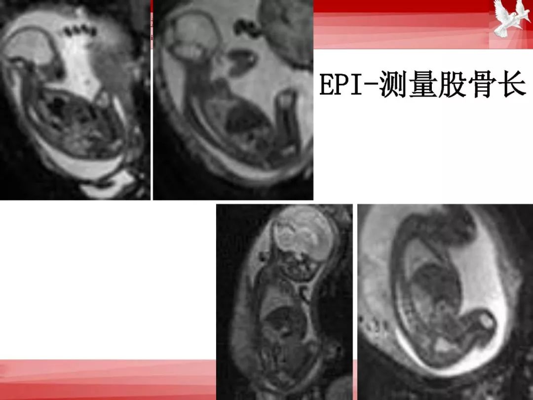 影像PPT - 【PPT】胎儿磁共振检查技术-80
