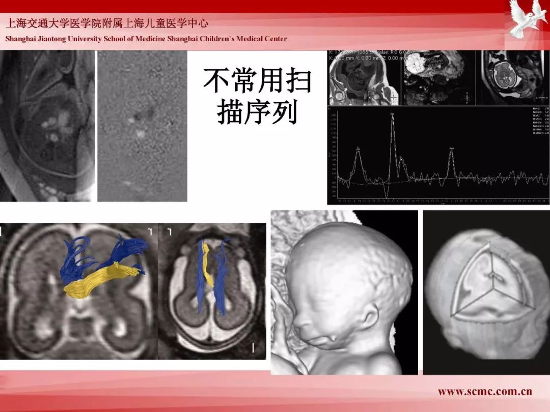 影像PPT - 【PPT】胎儿磁共振检查技术-82