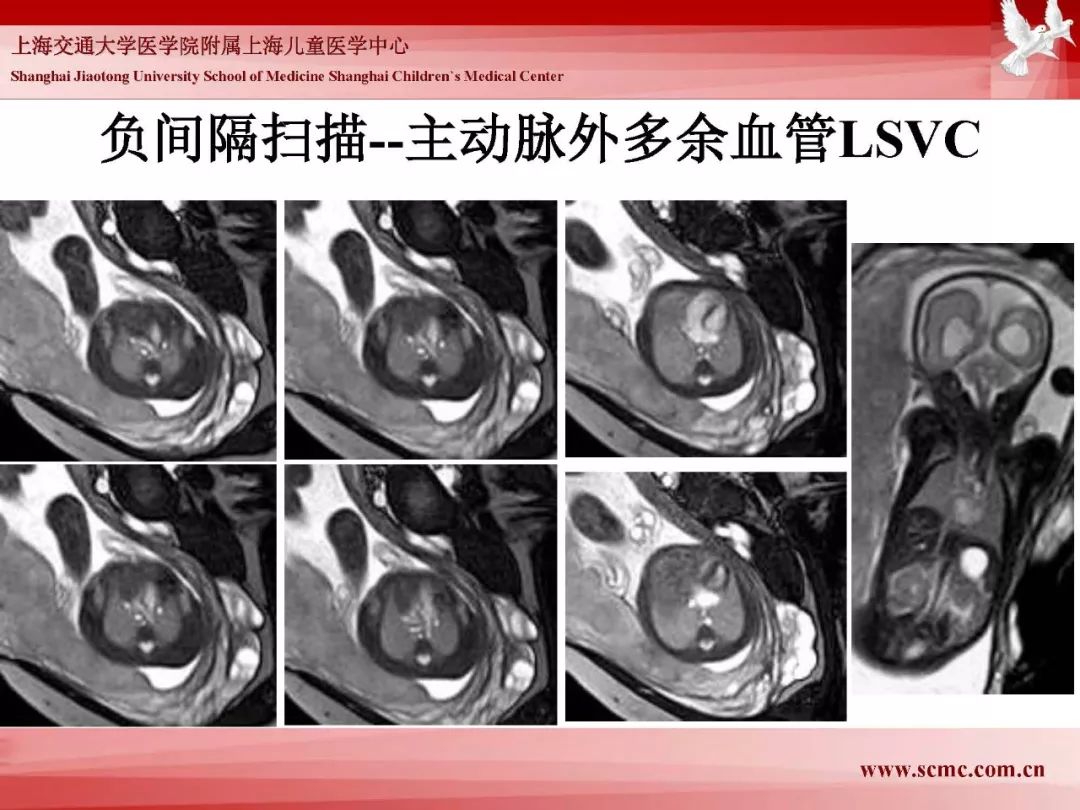 影像PPT - 【PPT】胎儿磁共振检查技术-84