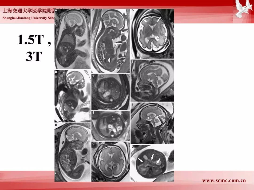 影像PPT - 【PPT】胎儿磁共振检查技术-86