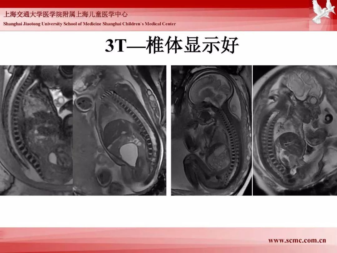 影像PPT - 【PPT】胎儿磁共振检查技术-87