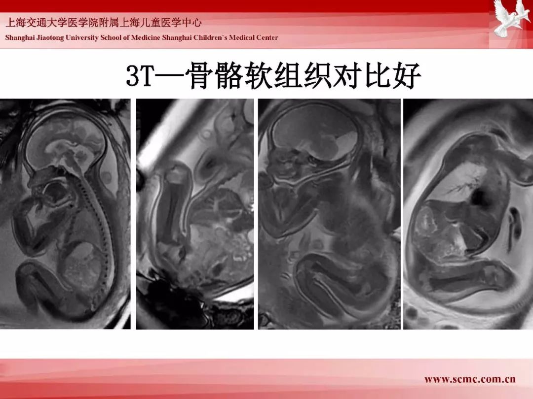 影像PPT - 【PPT】胎儿磁共振检查技术-88