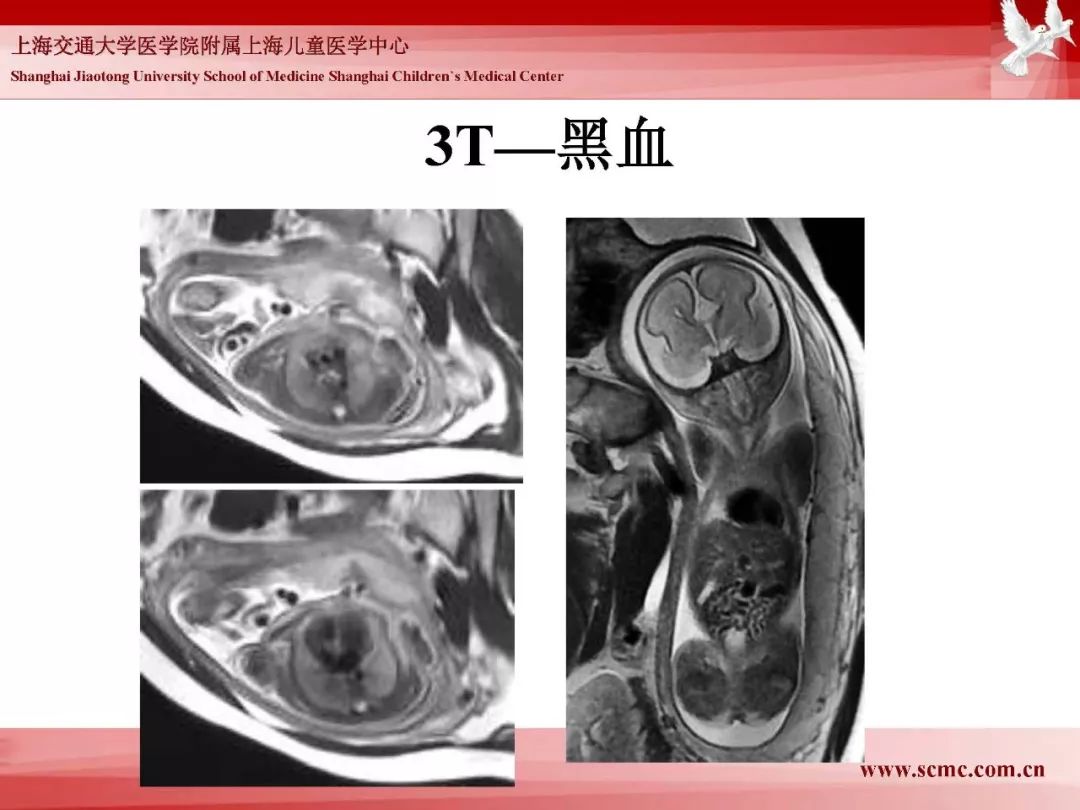 影像PPT - 【PPT】胎儿磁共振检查技术-90