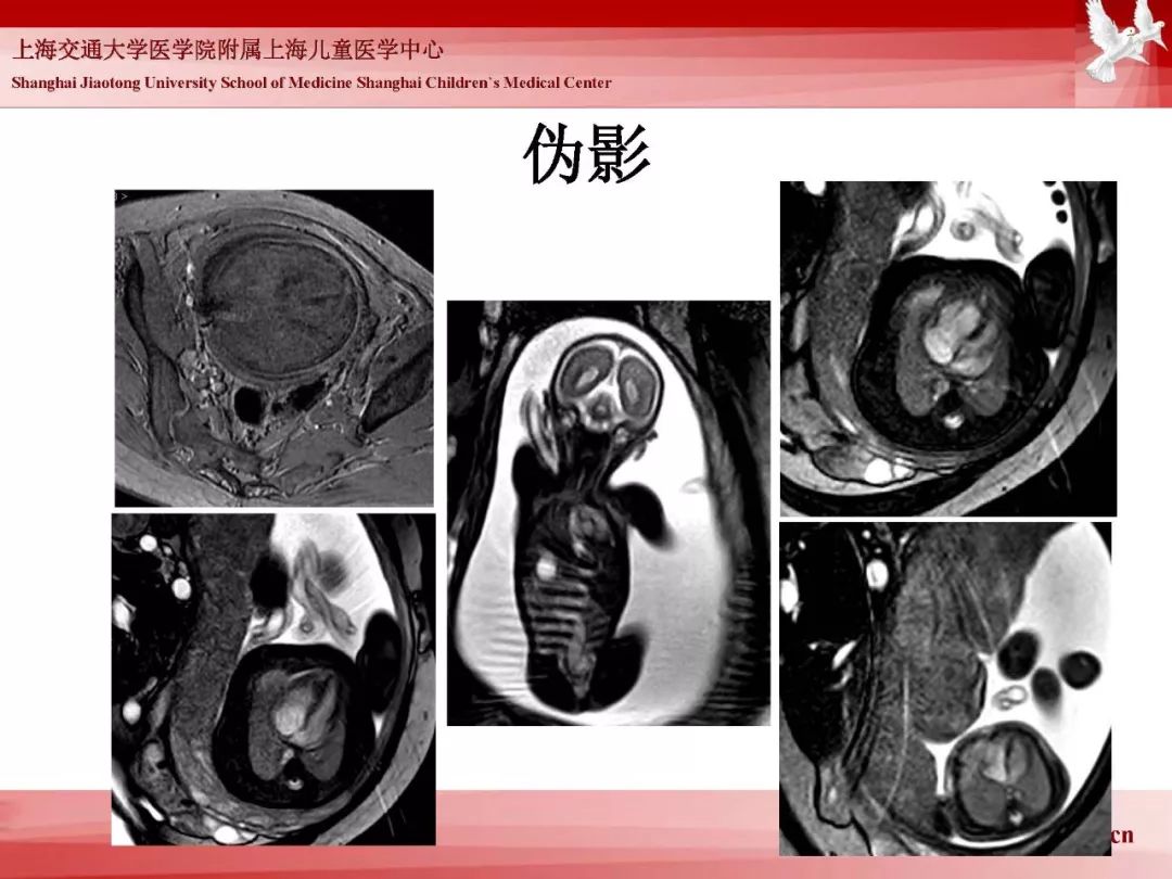 影像PPT - 【PPT】胎儿磁共振检查技术-92
