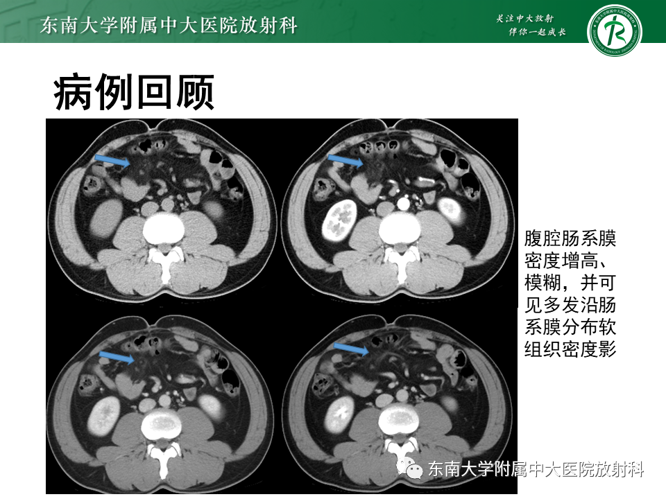影像PPT - 【PPT】肠系膜脂膜炎-2