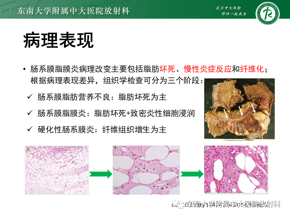 影像PPT - 【PPT】肠系膜脂膜炎-8